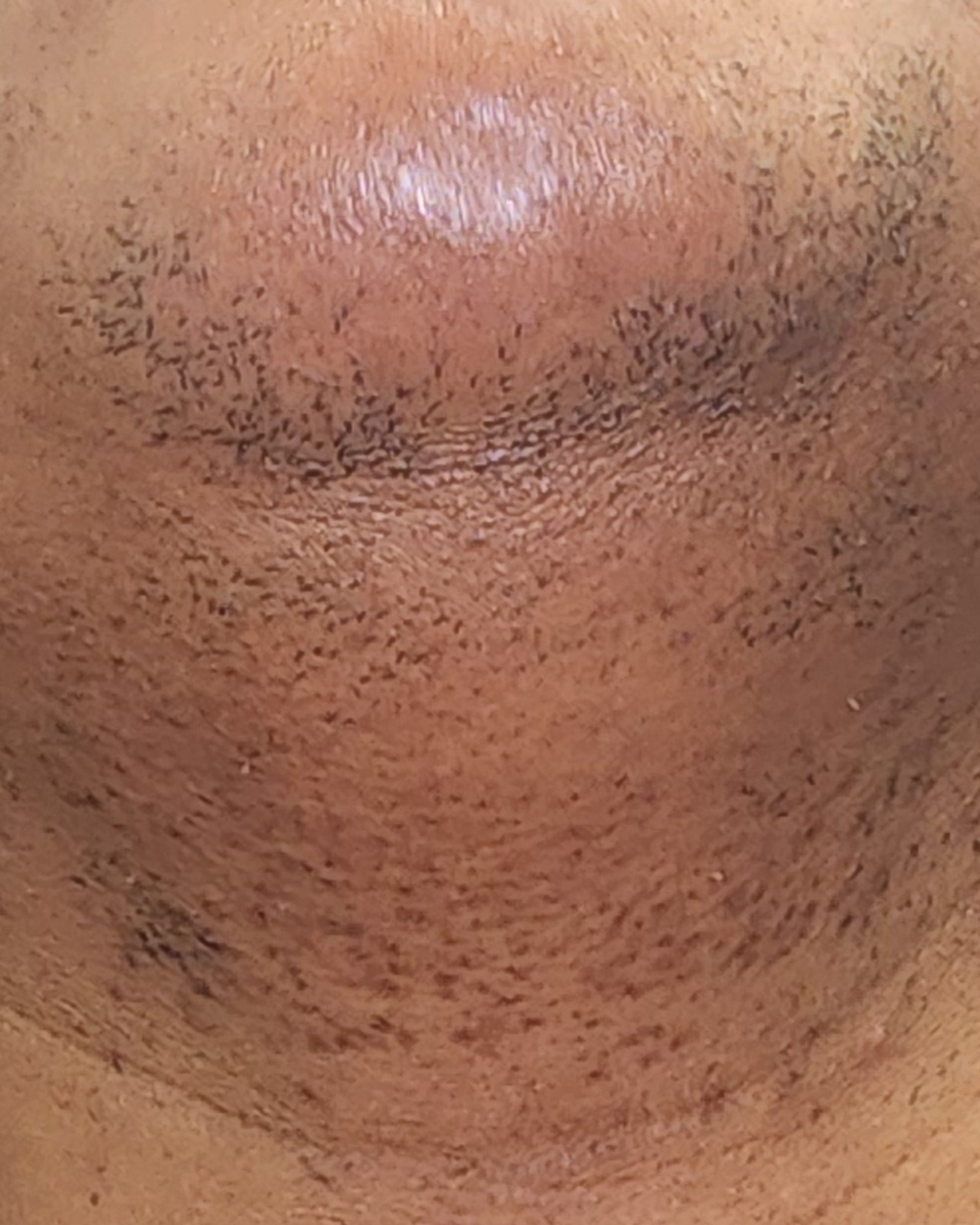 Laser Hair Removal Hair Line Clean Up (20)