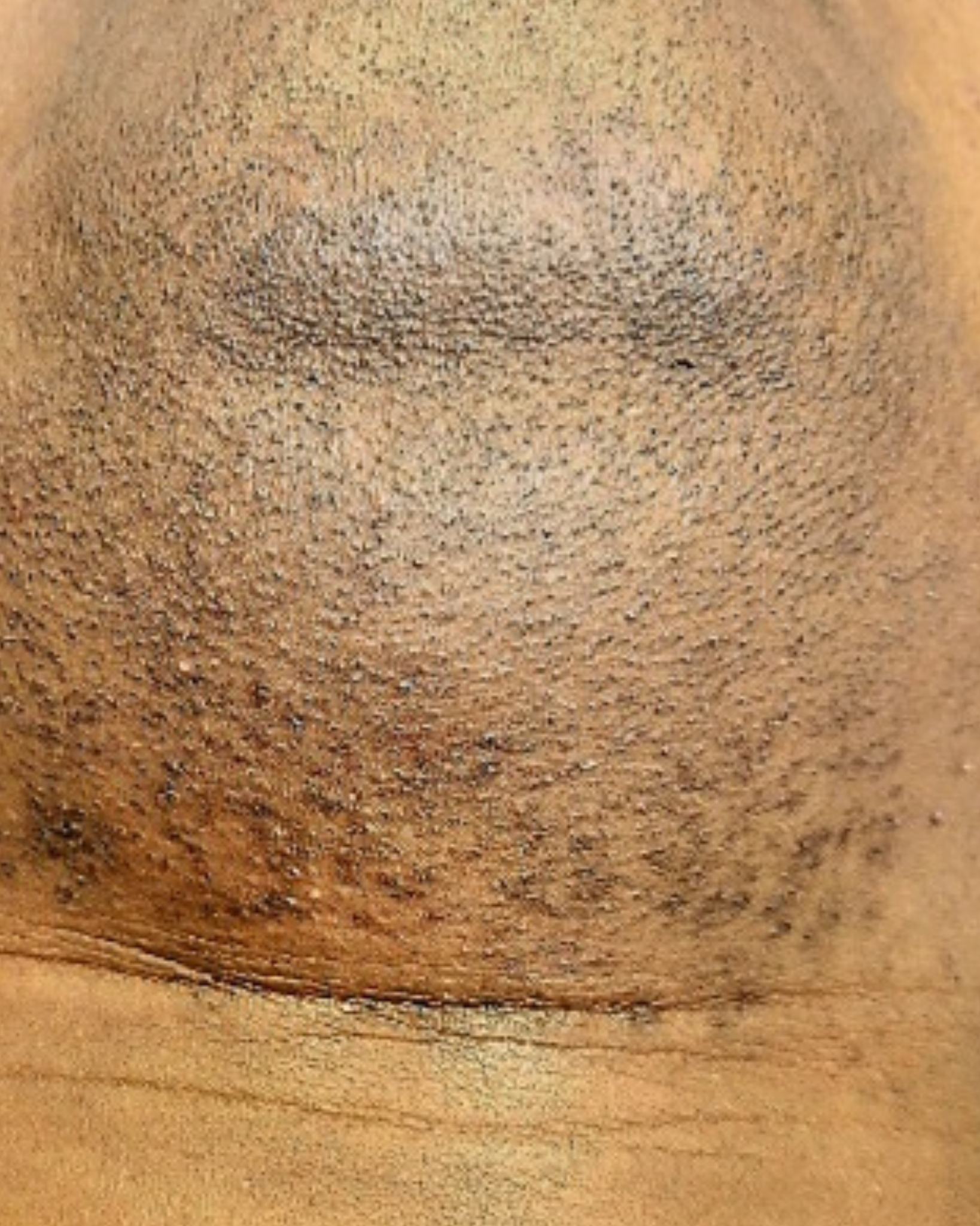 Laser Hair Removal Hair Line Clean Up (21)