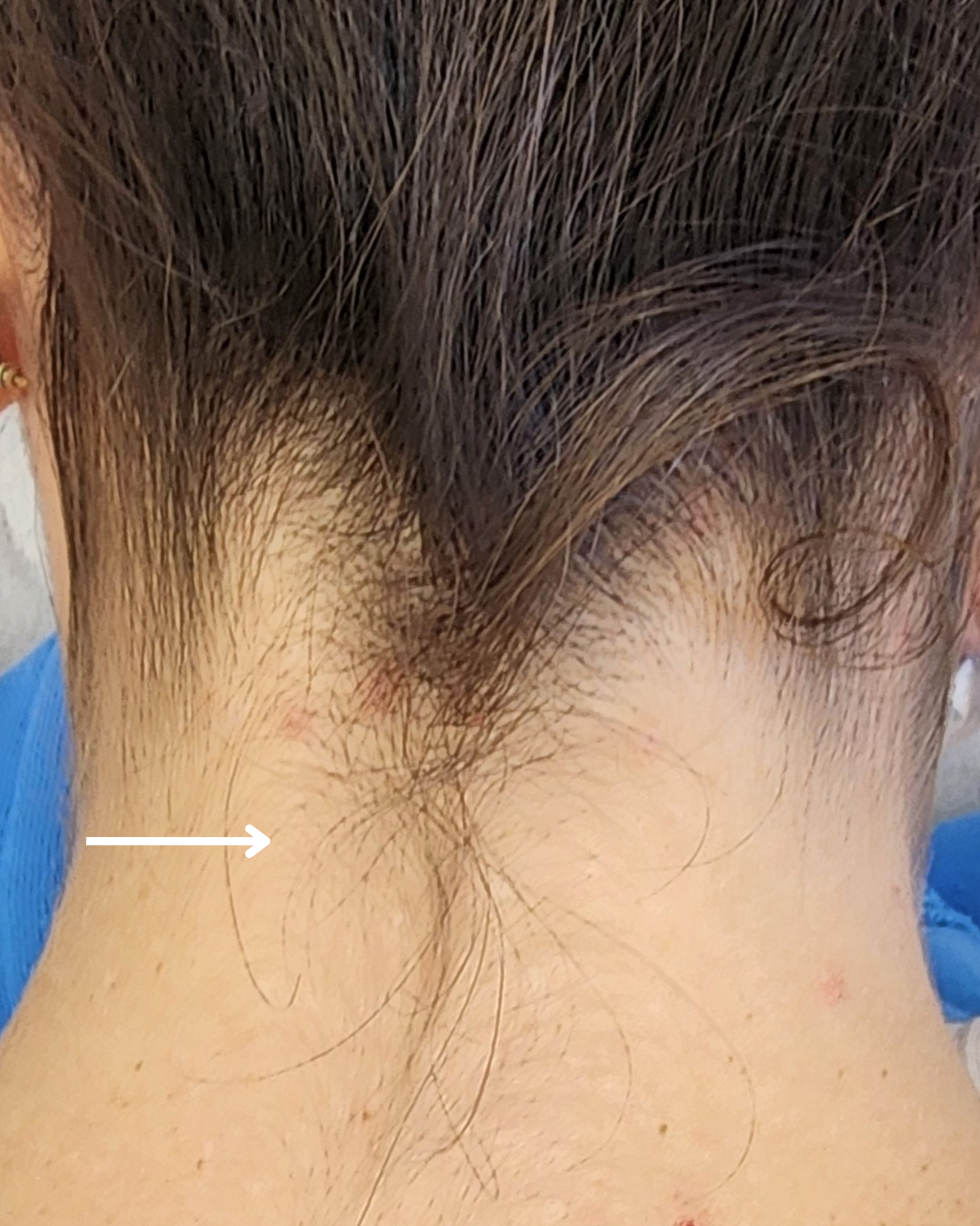 Laser Hair Removal Hair Line Clean Up (23)
