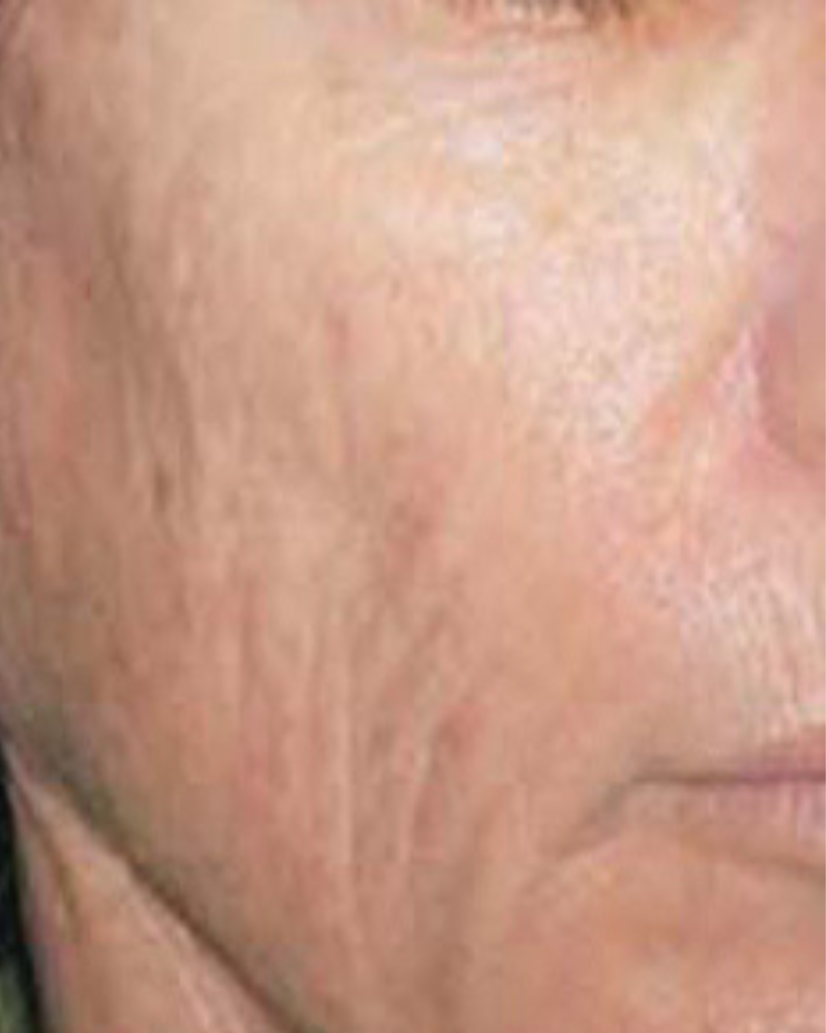 Laser Hair Removal Hair Line Clean Up (45)