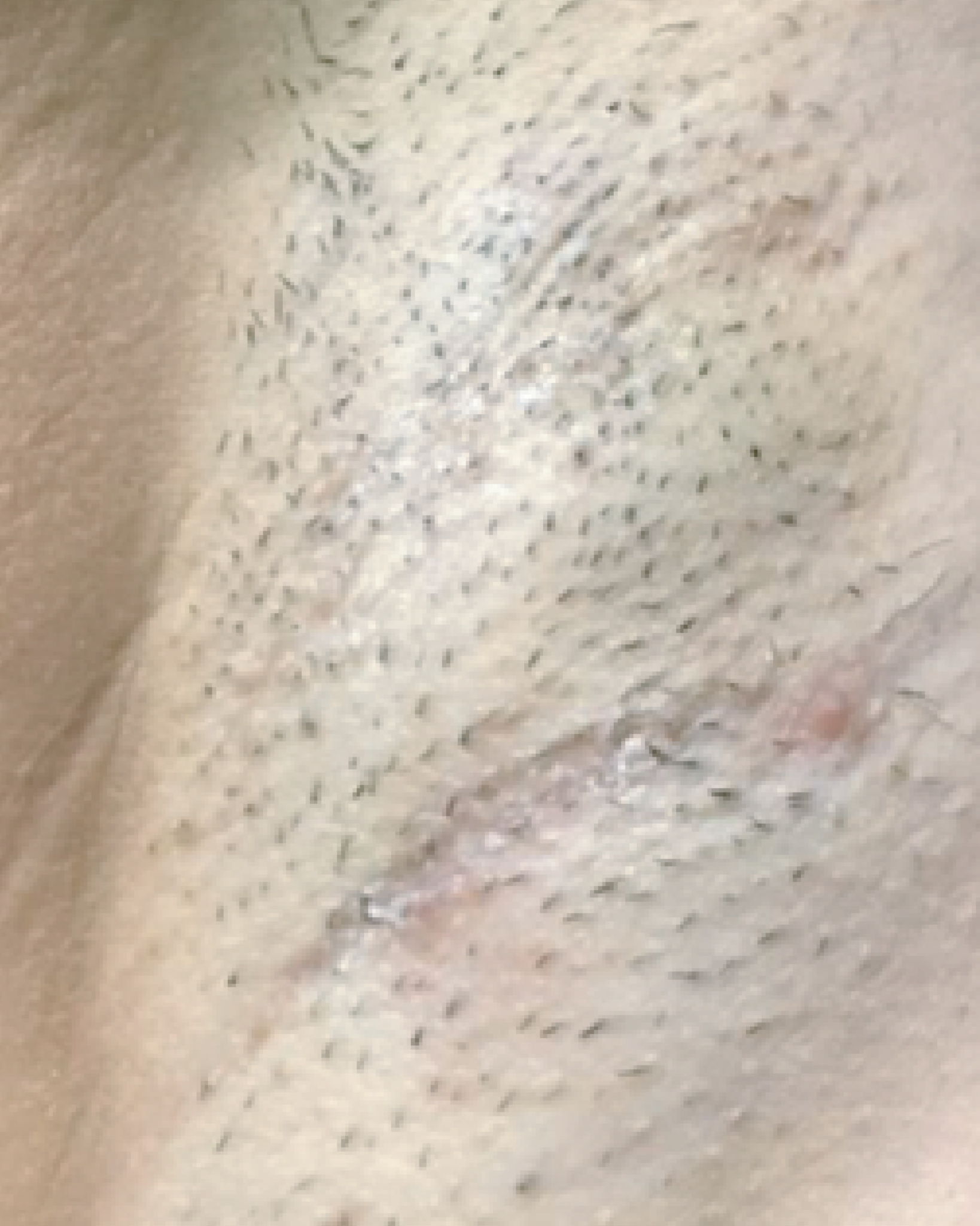 Laser Hair Removal Hair Line Clean Up (8)