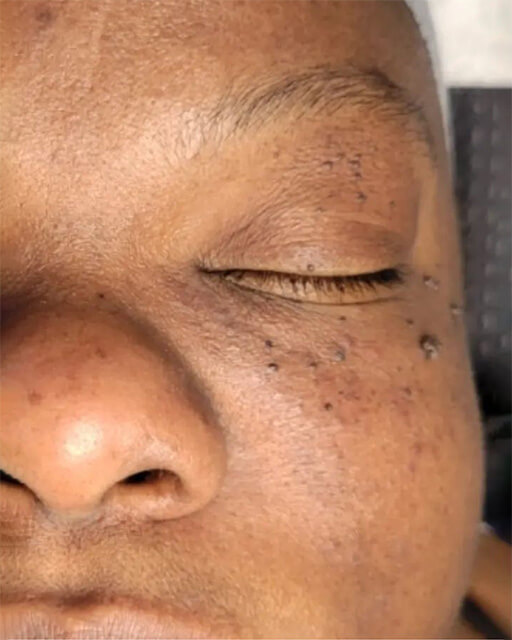 Laser-Hair-Removal-Hair-Line-Clean-Up-16