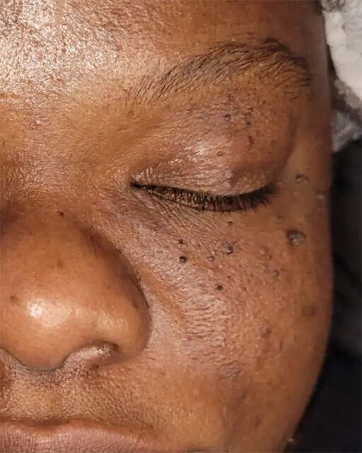 Laser-Hair-Removal-Hair-Line-Clean-Up-17