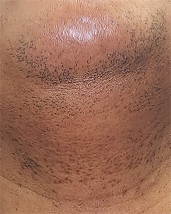 Laser-Hair-Removal-Hair-Line-Clean-Up-20
