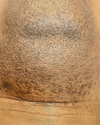 Laser-Hair-Removal-Hair-Line-Clean-Up-21