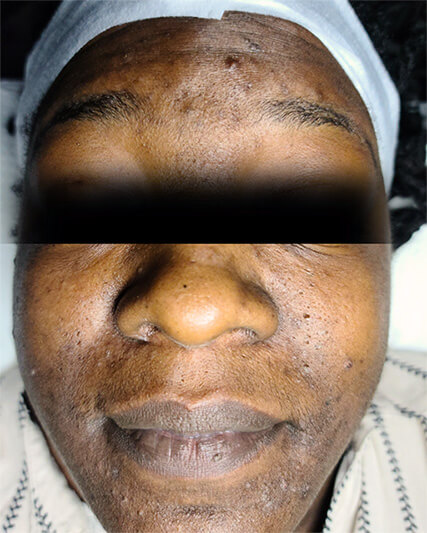 Laser-Hair-Removal-Hair-Line-Clean-Up-26