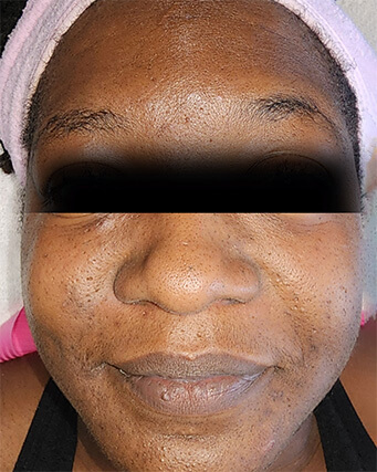 Laser-Hair-Removal-Hair-Line-Clean-Up-27