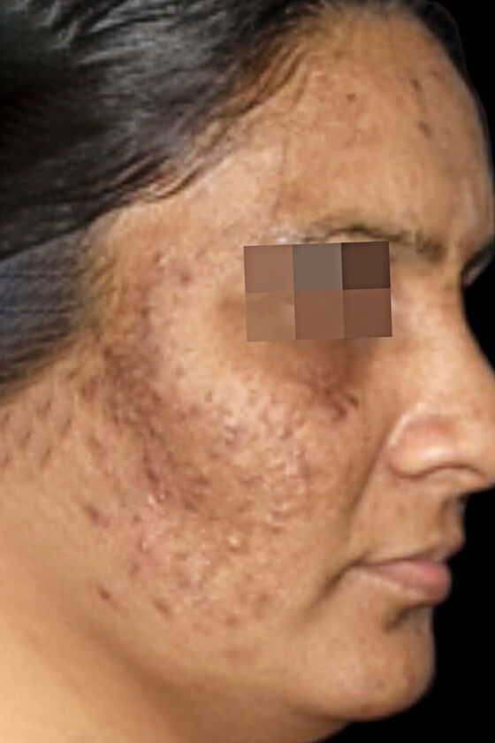 Laser-Hair-Removal-Hair-Line-Clean-Up-31