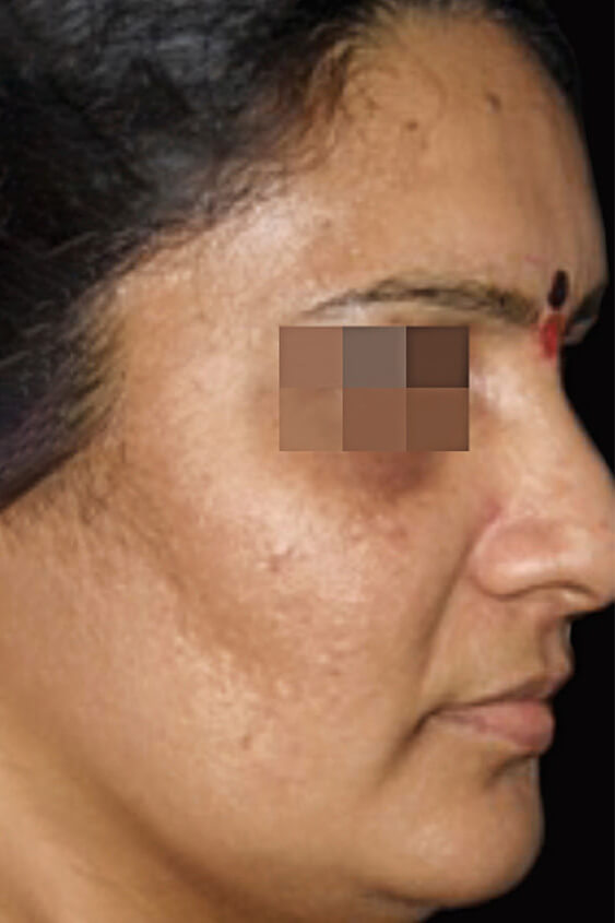 Laser-Hair-Removal-Hair-Line-Clean-Up-32