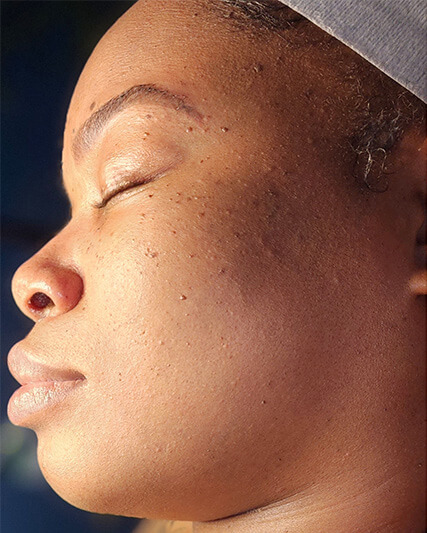 Laser-Hair-Removal-Hair-Line-Clean-Up-33