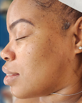Laser-Hair-Removal-Hair-Line-Clean-Up-34