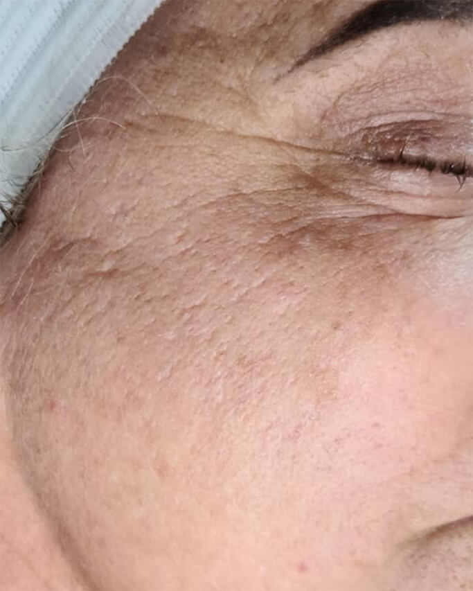 Laser-Hair-Removal-Hair-Line-Clean-Up-35