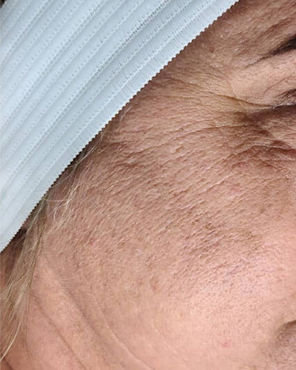 Laser-Hair-Removal-Hair-Line-Clean-Up-37