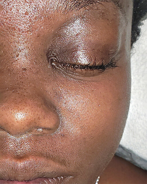 Laser-Hair-Removal-Hair-Line-Clean-Up-39