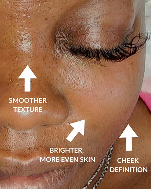 Laser-Hair-Removal-Hair-Line-Clean-Up-40
