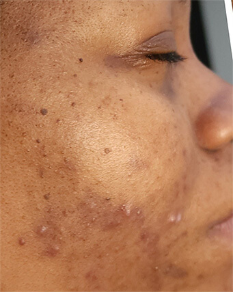 Laser-Hair-Removal-Hair-Line-Clean-Up-43
