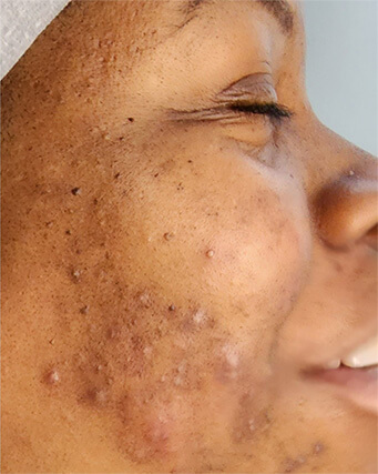Laser-Hair-Removal-Hair-Line-Clean-Up-44