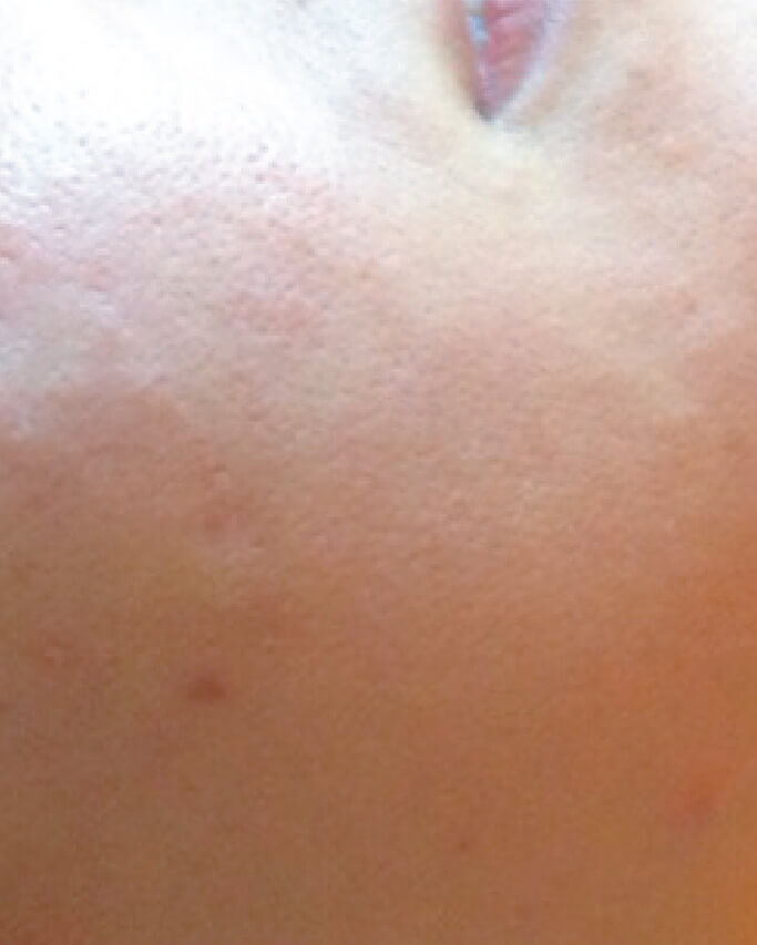 Laser-Hair-Removal-Hair-Line-Clean-Up-47