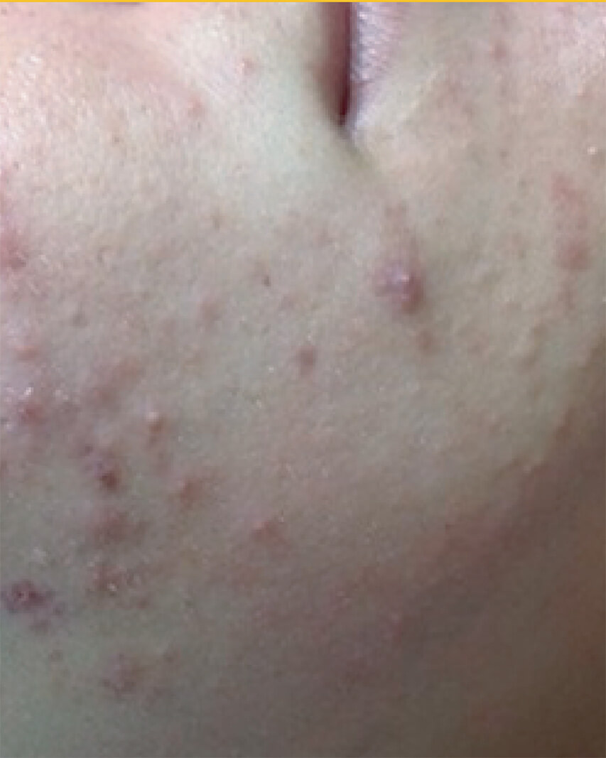 Laser-Hair-Removal-Hair-Line-Clean-Up-48 (1)